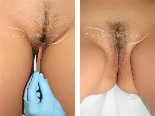 circumcised vagina. finish product.