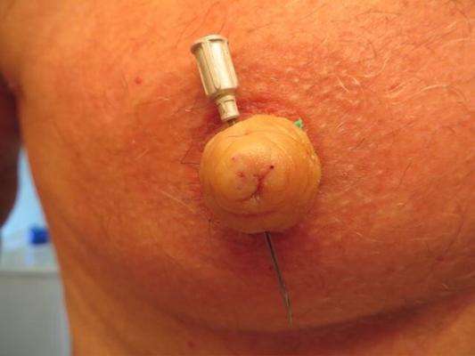 nipples needles and pins