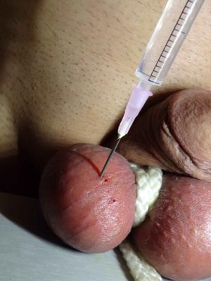 Saline Injections