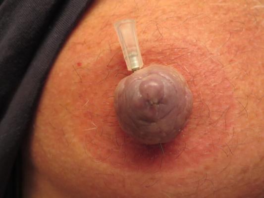 The latest needle nipple pictures